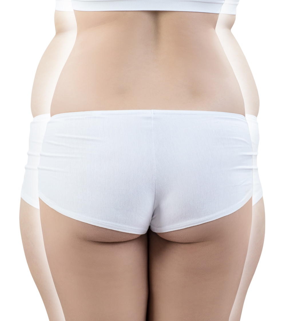 Lipoaspiration
