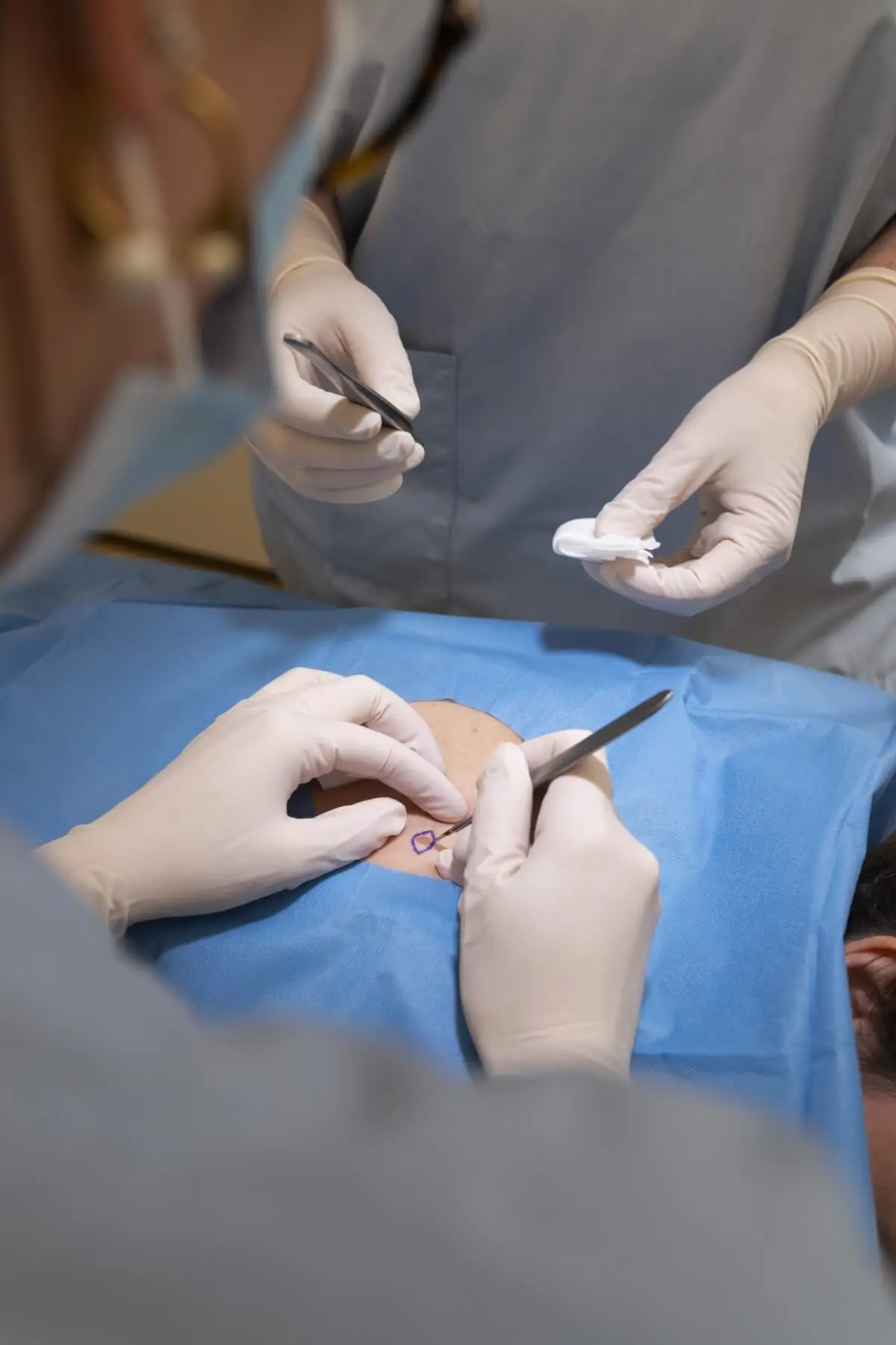 Docteur Marine HITIER - chirurgie tumeurs cutanées à Annecy